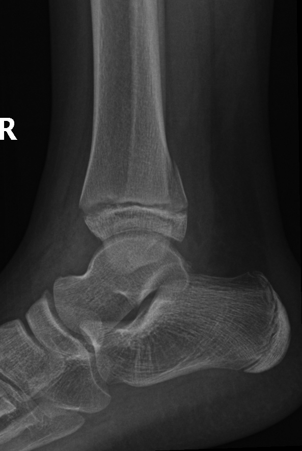<p>What type of Salter-Harris fracture is most common in the radius and ulna?</p>