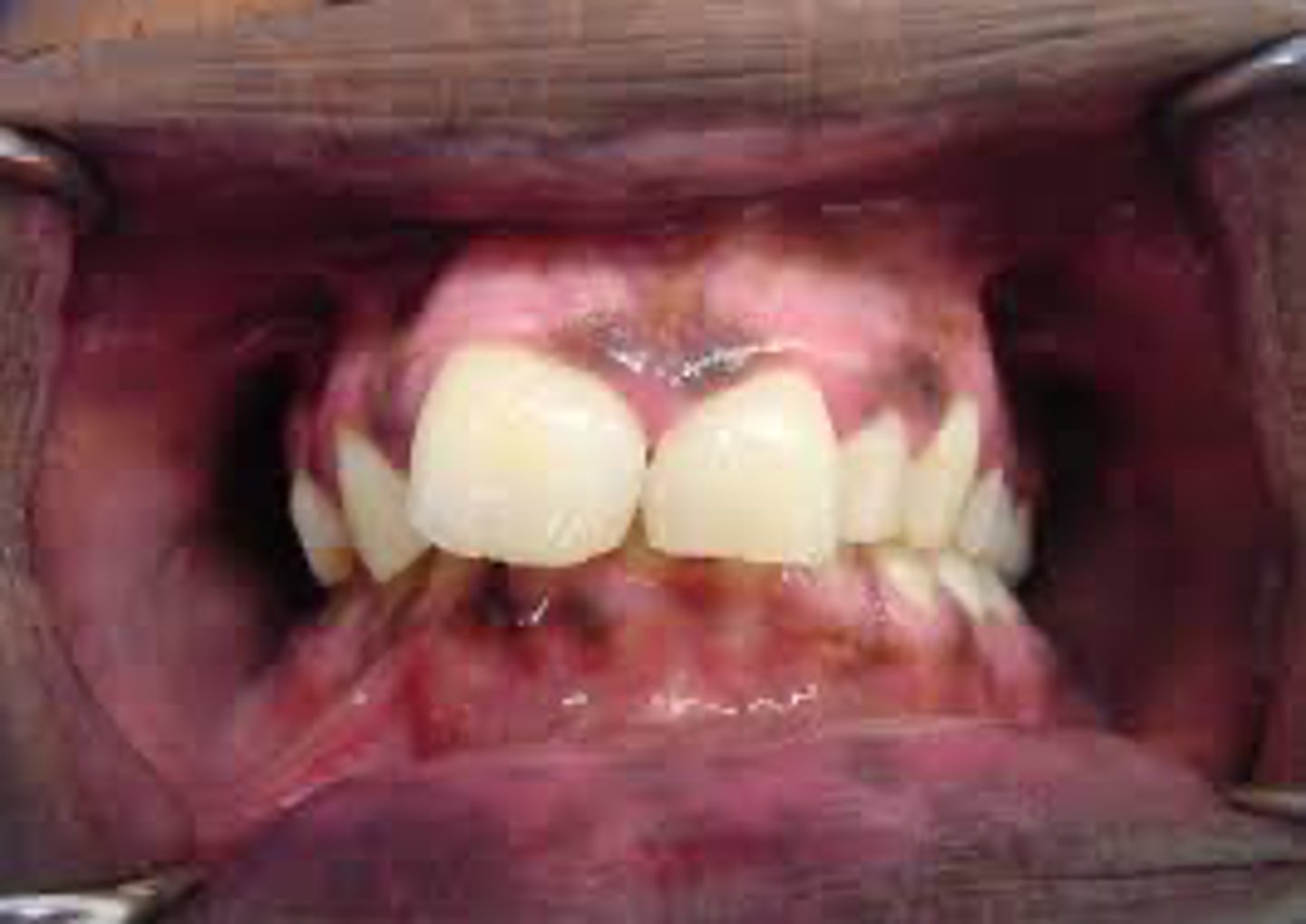 <p>A patient presents with multiple brown macules on the lips, oral mucosa, and perioral skin. The patient reports these lesions have been present since early childhood. Medical history reveals intestinal polyps.</p><p>Which of the following is the LEAST likely diagnosis?</p>