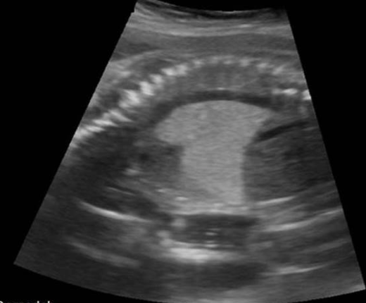 <p>a) diaphragmatic hernia</p><p>b) normal lung tissue in 3rd trimester</p><p>c) congenital cystic adenomatoid malformation type 2</p><p>d) Congenital cystic adenomatoid malformation type 3</p>