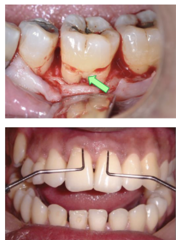 <ul><li><p>cervical enamel projection</p></li><li><p>radical groove</p></li></ul><p></p>