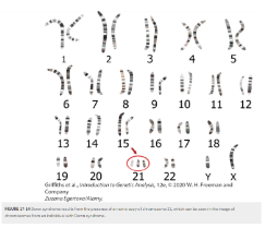 <p><span>Of human trisomies, the most familiar type is Down syndrome.</span></p><ul><li><p><span>Most affected persons have an extra copy of chromosome 21 caused by nondisjunction of chromosome 21 in a parent who is chromosomally normal. </span></p></li><li><p><span>In this sporadic type of Down syndrome, there is no family history of aneuploidy. </span></p></li><li><p><span>Some rarer types of Down syndrome arise from translocations; in these cases, Down syndrome recurs in the pedigree because the translocation may be transmitted from parent to child.</span></p></li></ul><p></p>
