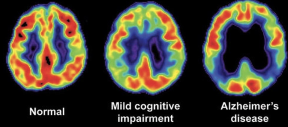  PET (positron emission tomography) scan mechanism 

\-functional indirect