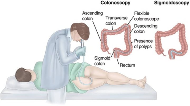 <p>Visualization of colon using a flexible scope.</p>