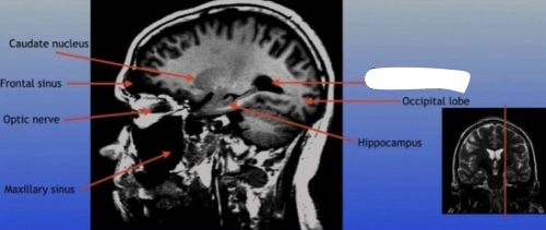 <p>The posterior part of the lateral ventricle, involved in the production and circulation of cerebrospinal fluid within the brain. </p>