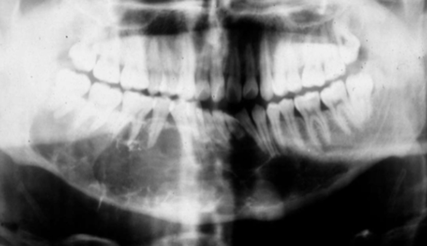 <p>Patient presents with an expansion on the posterior mandible. Radiograph shows a multi-locular, "soap bubble" radiolucency with wispy trabecular resembling cobwebs that are more angular in shape and cause root resorption and displacement.</p><p>What is the diagnosis?</p>