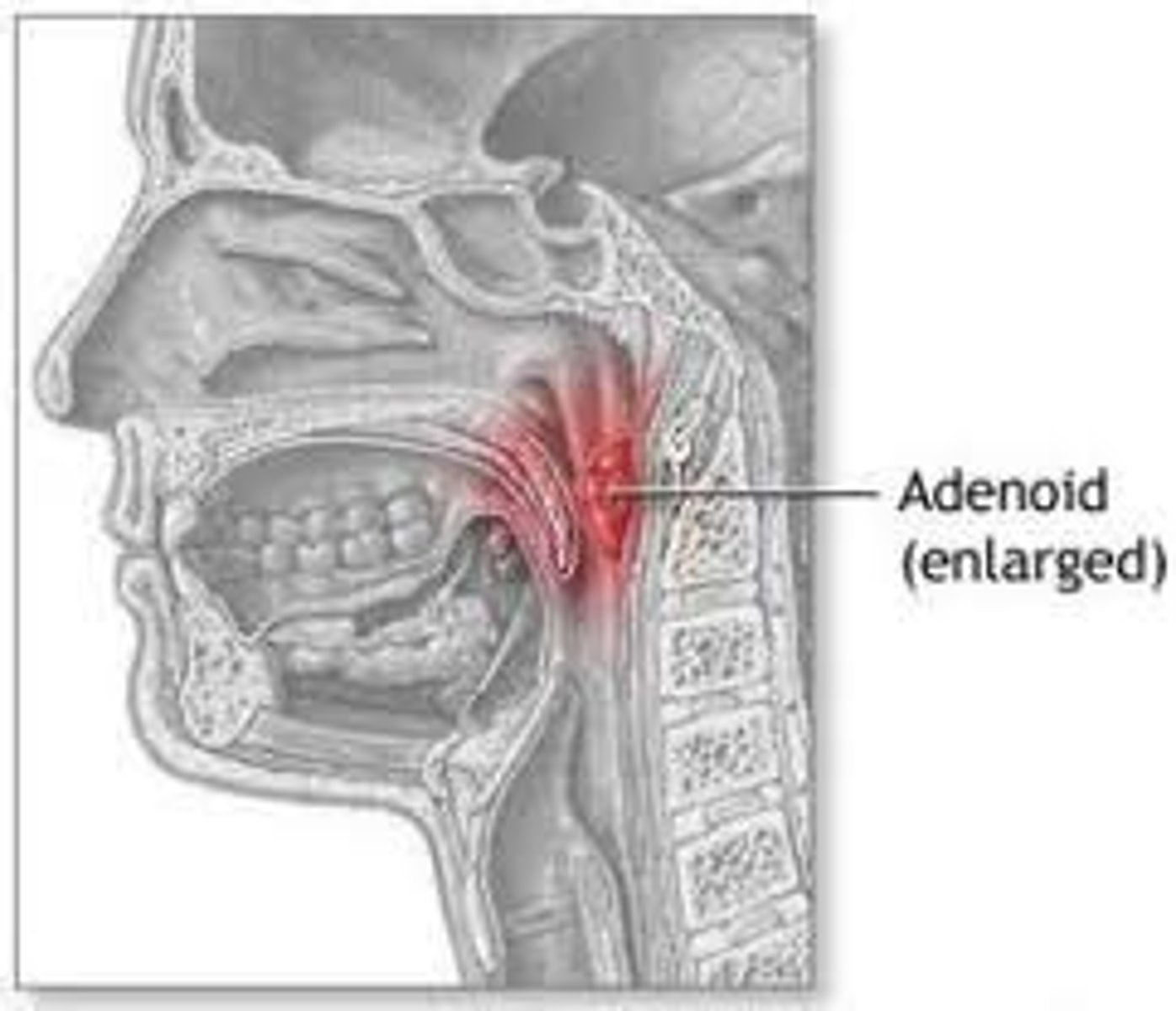 <p>inflammation of the adenoids</p>