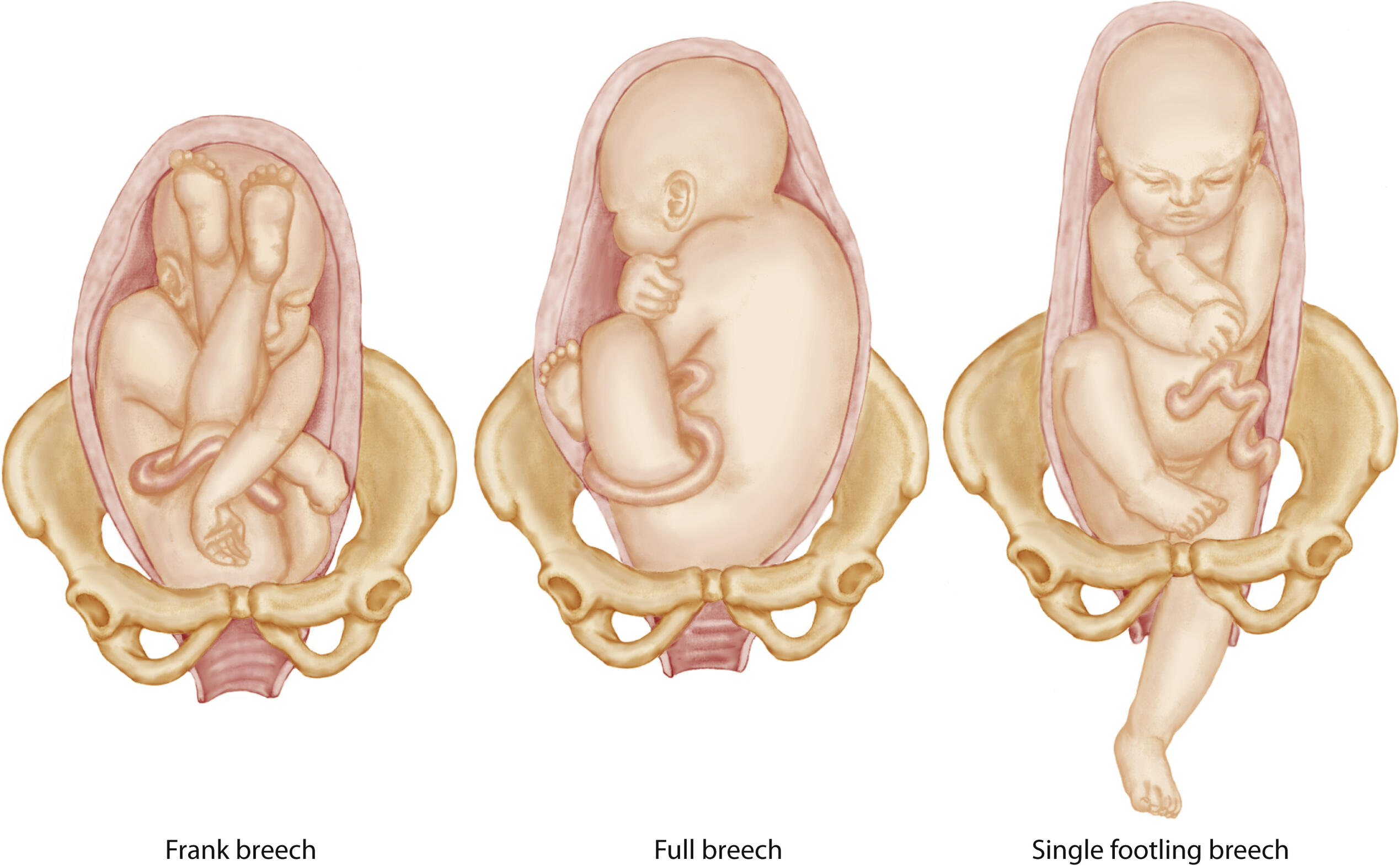 <p>the most common, the fetal legs are extended across the abdomen towards the shoulder</p>
