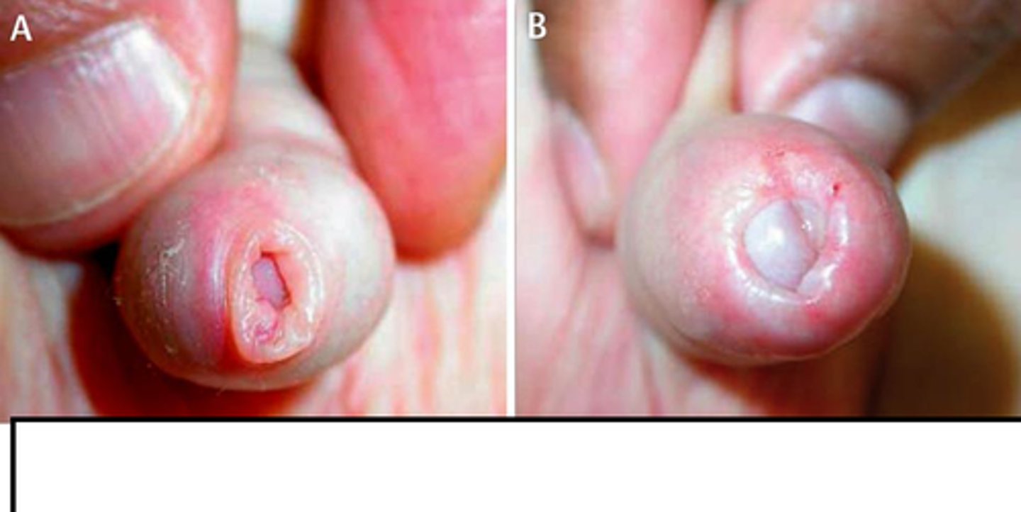 <p>Fibrous constriction of the foreskin that prevents its retraction; poor hygiene</p>