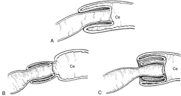 <p>This picture shows the small intestine telescoping into itself. What disease process does this picture indicate?</p><p>a. Malrotation</p><p>b. Intussusception</p><p>c. Appendicitis</p><p>d. Celiac</p>