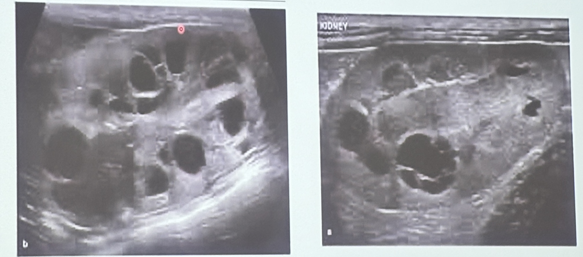 <p>These are long axis scans for the left &amp; right kidneys of a 7yo DSH with a history of azotemia. What are the ultrasonographic findings?</p>