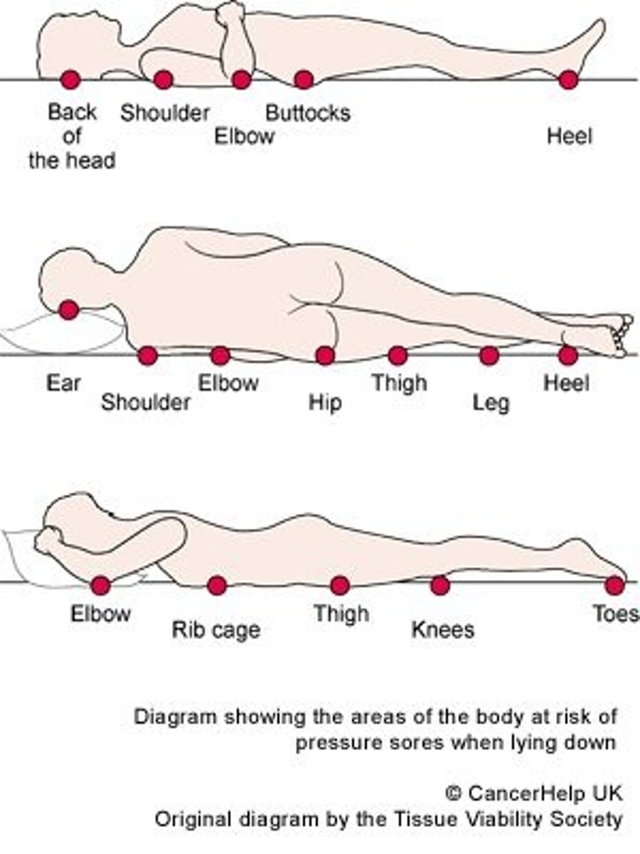 <p>The least padded areas (elbow, heels, backbone)</p>