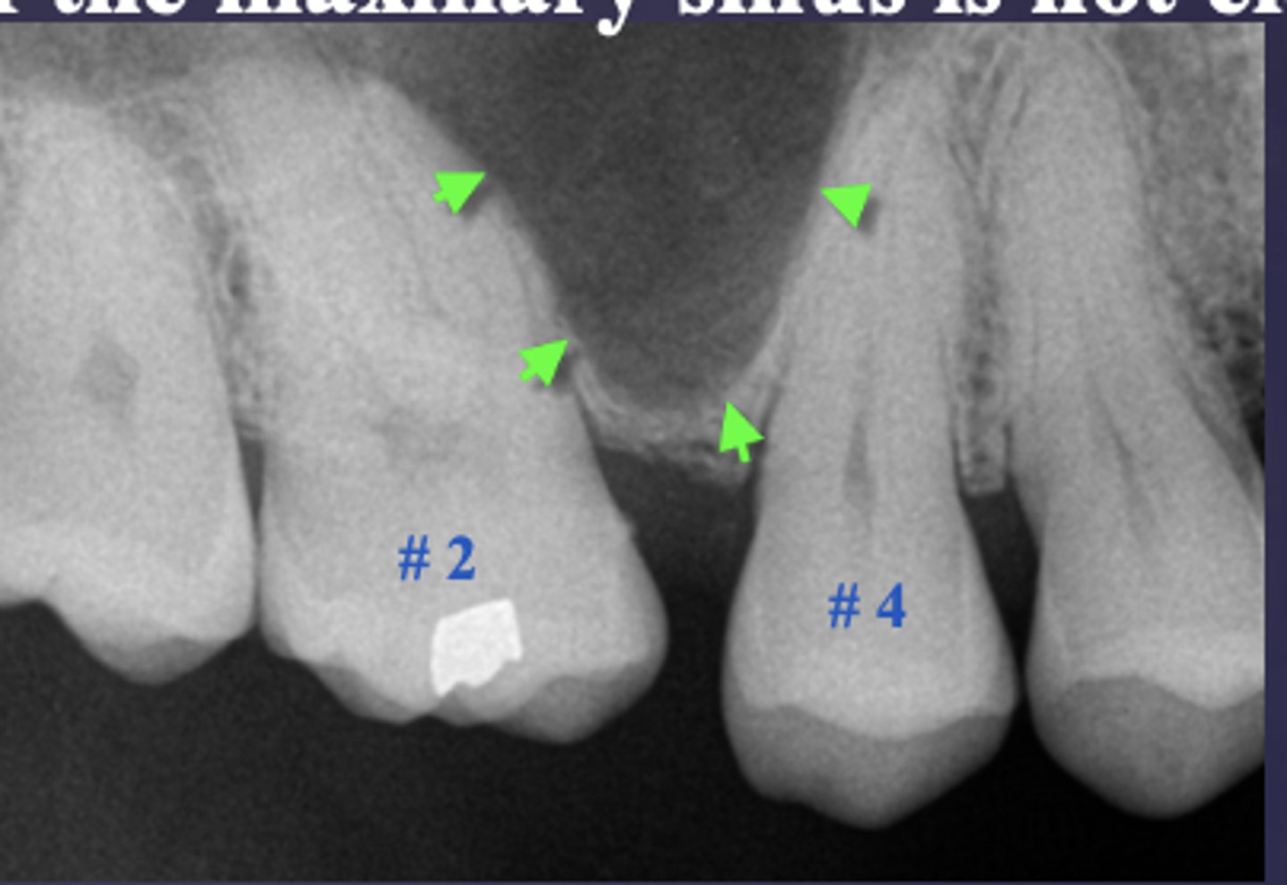 <p>What is the differential diagnosis?</p><p>A) Rarefying osteitis</p><p>B) Maxillary sinus pneumatization</p><p>C) Mucus retention pseudocyst</p><p>D) Sclerosing osteitis</p>