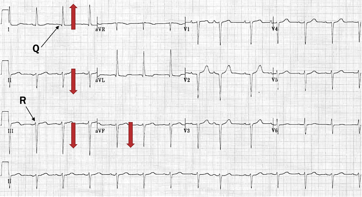 <p>LAD- pos I and neg aVF</p><p>Q wave in I and R wave in III- q1r3</p><p>mostly neg II</p><p>mostly neg III</p>