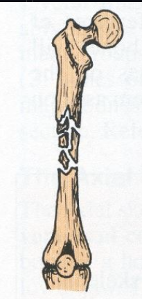 Comminuted fracture
