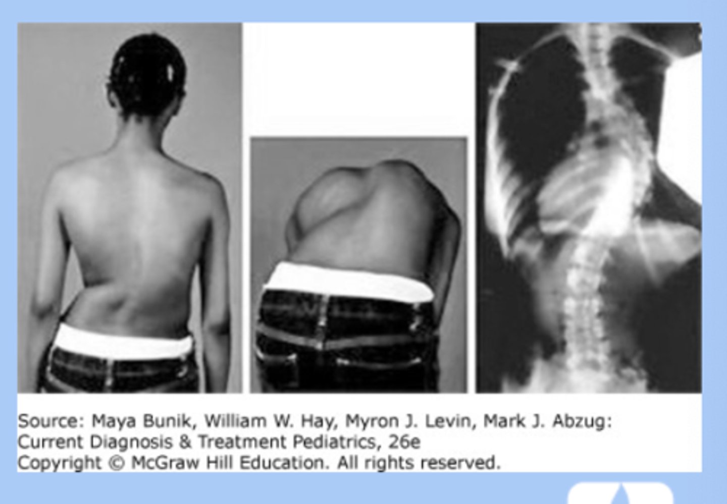 <p>-lateral spine curvature + vertebral rotation </p><p>-location thoracic </p><p>-idiopathic (80%), girl 10-12 </p><p>-sx: usually painless, deformity of rib cage, scapular wing</p><p>-screening: adams forward bend test at age 9 </p><p>-dx: XR</p><p>-tx: waitful watching, bracing, surgery </p>