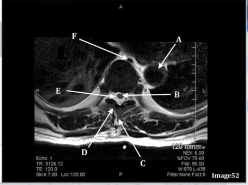 <p>Letter F in Image 52 is pointing to:</p><p>A. Abdominal aorta</p><p>B. Inferior vena cava</p><p>C. Spinal cord</p><p>D. Cerebrospinal fluid</p><p>E. Azygos vein</p>