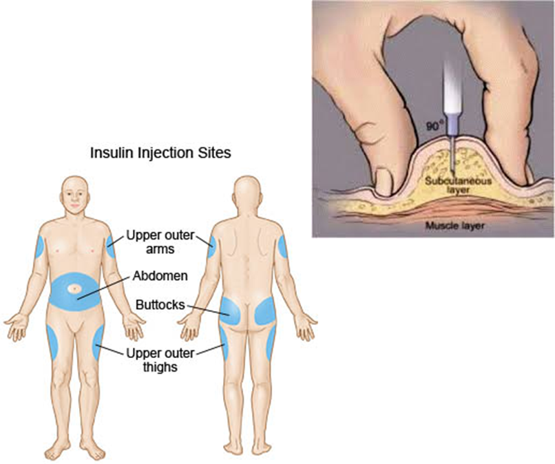 <ul><li><p>SC (into hypodermis)</p><ul><li><p>SC needle injections</p></li><li><p>portable pen injectors (usually for pt, we dont use it)</p></li><li><p>insulin pumps – basal &amp; bolus delivery</p></li></ul></li><li><p>IV=utilized in critically ill patients</p></li></ul><p></p>