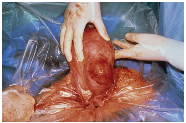 <ul><li><p><span style="background-color: transparent;"><u><span>Noncancerous</span></u><span> growths composed of muscular and fibrous tissue.</span></span></p></li><li><p><span style="background-color: transparent;"><u><span>Found</span></u><span> in the uterus, endometrium, or on the outside of the uterus.</span></span></p></li><li><p><span style="background-color: transparent;"><span>Usually </span><u><span>left alone </span></u><span>if it is not causing problems</span></span></p></li><li><p><span style="background-color: transparent;"><span>Usually </span><u><span>removed</span></u><span> if it is causing pain or bleeding; or if it grows too large; can cause infertility</span></span></p></li></ul><p></p>