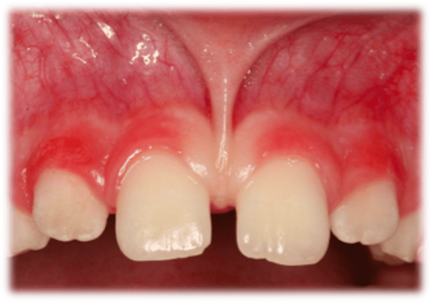 <p>Interdental col is not present if there is large space between 2 teeth or if there is notable gingival recession</p>