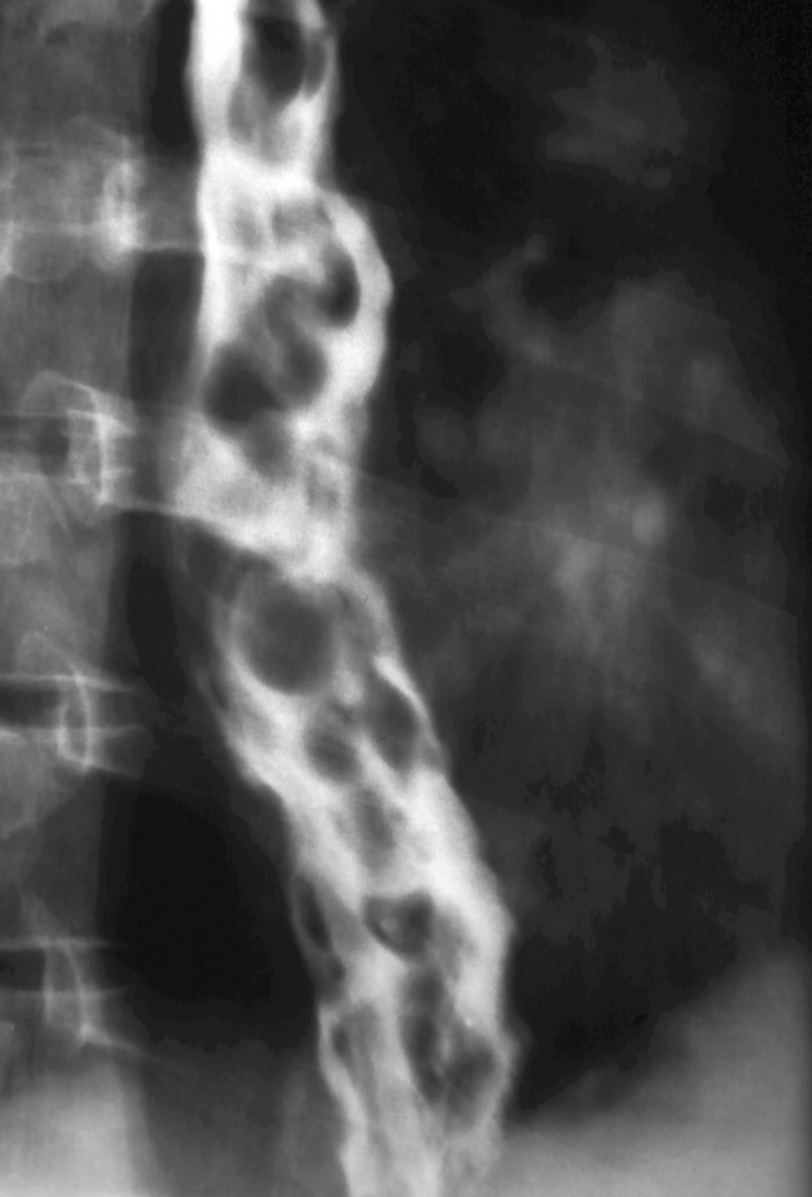 <p>What pathology is shown here?</p>