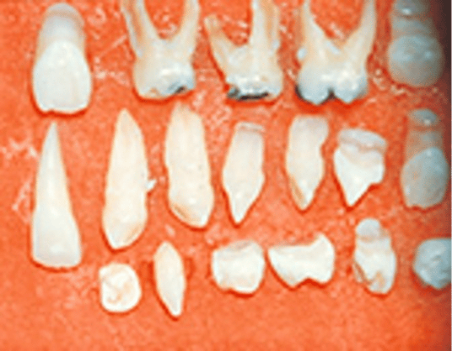 <p>supernumerary teeth extracted resulting from the cranium developing into a mushroom shape because the fontanelles remain open</p>
