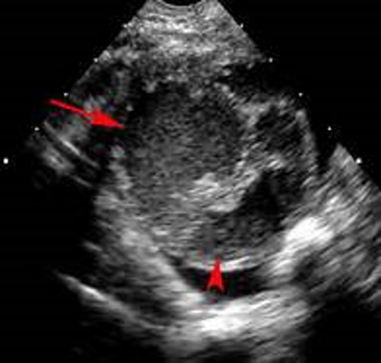 <p>Sonography reveals a multiloculated adnexal mass</p><p>CT can rule out other causes of an acute abdomen</p><p>Bilateral involvement can occur</p>