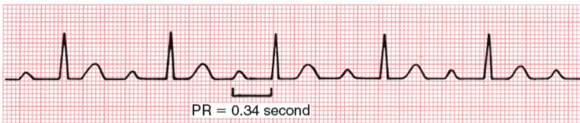 <p><span>degree of AV block with prolonged PR interval, not complete block</span></p>