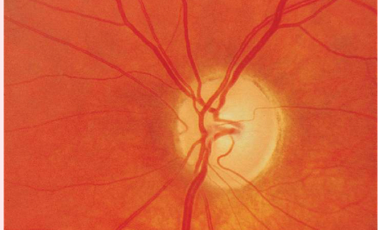 <p>optic atrophy</p>