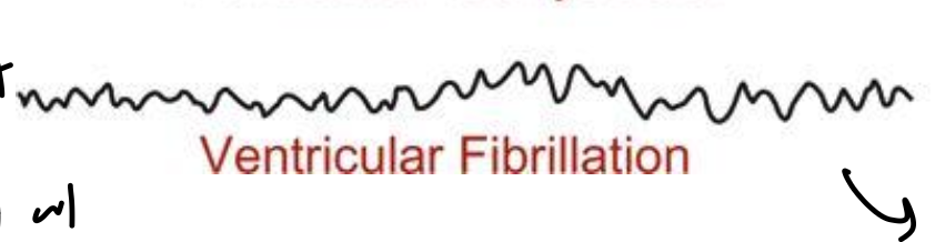 <ul><li><p>filling so low that cannot supply to body</p></li><li><p>no contractions as ejection from ventricle stopped</p></li></ul><p></p>