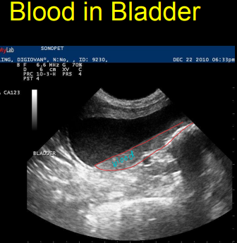 <ul><li><p><strong>Benign</strong></p><ul><li><p><strong>Calculi</strong></p><ul><li><p><strong>Hyperechoic</strong> with <strong>posterior shadowing</strong></p><ul><li><p>Don’t adhere to wall</p></li></ul></li><li><p><strong>Sand type</strong> looks like <strong>hyperechoic line</strong></p></li></ul></li><li><p><strong>Blood clots</strong></p><ul><li><p>Well defined, irregularly mass</p></li></ul></li><li><p><strong>Cystitis</strong></p><ul><li><p><strong>thick wall</strong></p></li><li><p>Inner mucosal margins are roughened</p></li><li><p><u>debris floating</u></p></li></ul></li><li><p><strong>Rupture</strong></p><ul><li><p>can cause an overlap seal</p></li><li><p><u>Most common</u> in <strong>apex</strong></p></li><li><p><strong>free fluid</strong></p></li></ul></li><li><p><strong>Ectopic ureter: always leaking urine from day 1</strong></p><ul><li><p>Moderate sensitivity, needs <strong>high frequency</strong> or <strong>doppler </strong>probe</p></li><li><p><strong>eddy formation</strong> as urine enters from ureter</p></li></ul></li></ul></li><li><p><strong>Malignant</strong></p><ul><li><p><strong>Transitional cell carcinoma: trigone</strong></p><ul><li><p><strong>defined irregular, </strong>sessile based</p></li><li><p><strong>caudodorsal</strong> or <strong>cranioventral</strong> (cats)</p></li></ul></li><li><p><u>Botryoid rhabdomyosarcoma</u></p><ul><li><p>rare, <strong>young </strong>dogs, <strong>“cluster of grapes”</strong></p></li></ul></li></ul></li></ul><p></p>