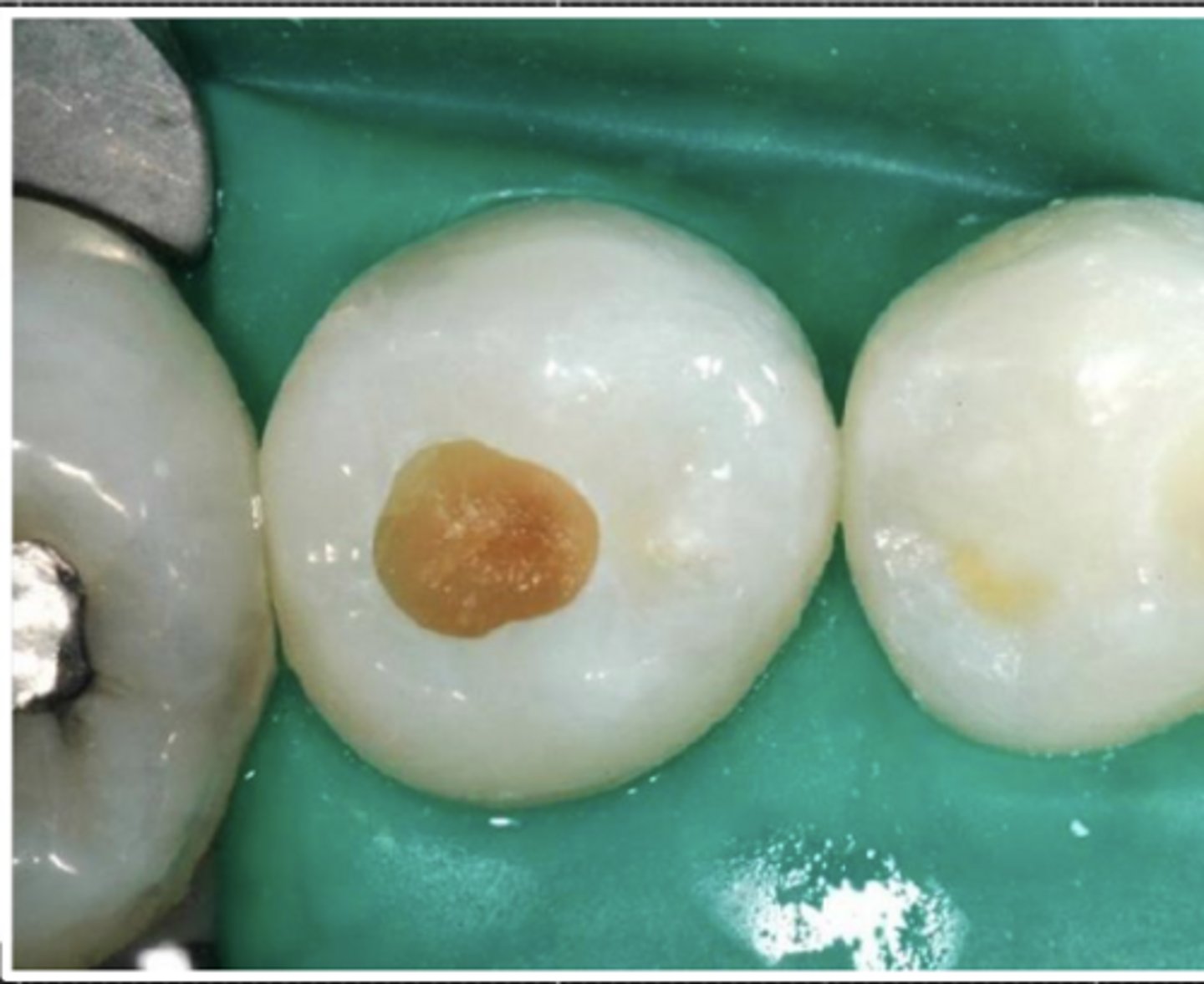 <p>soft/stained.</p><p>(Halo of yellow/hard dentin exposed)</p>