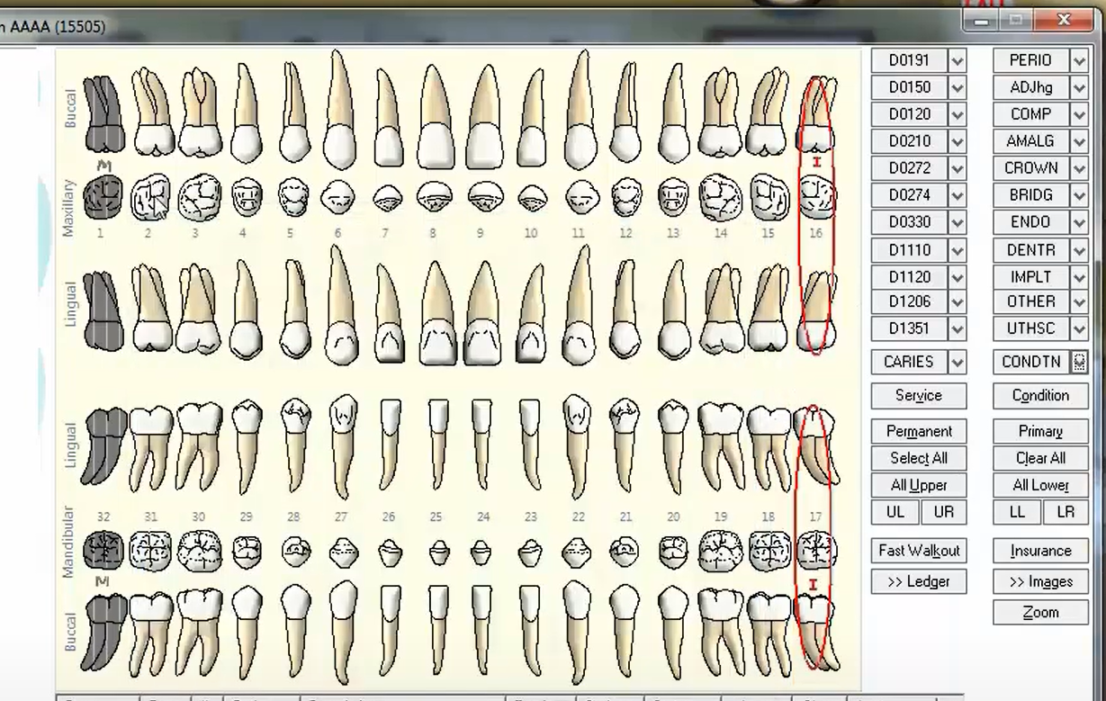 <p><span>In the chart pictured what is the condition of teeth #16 and #17?</span></p>