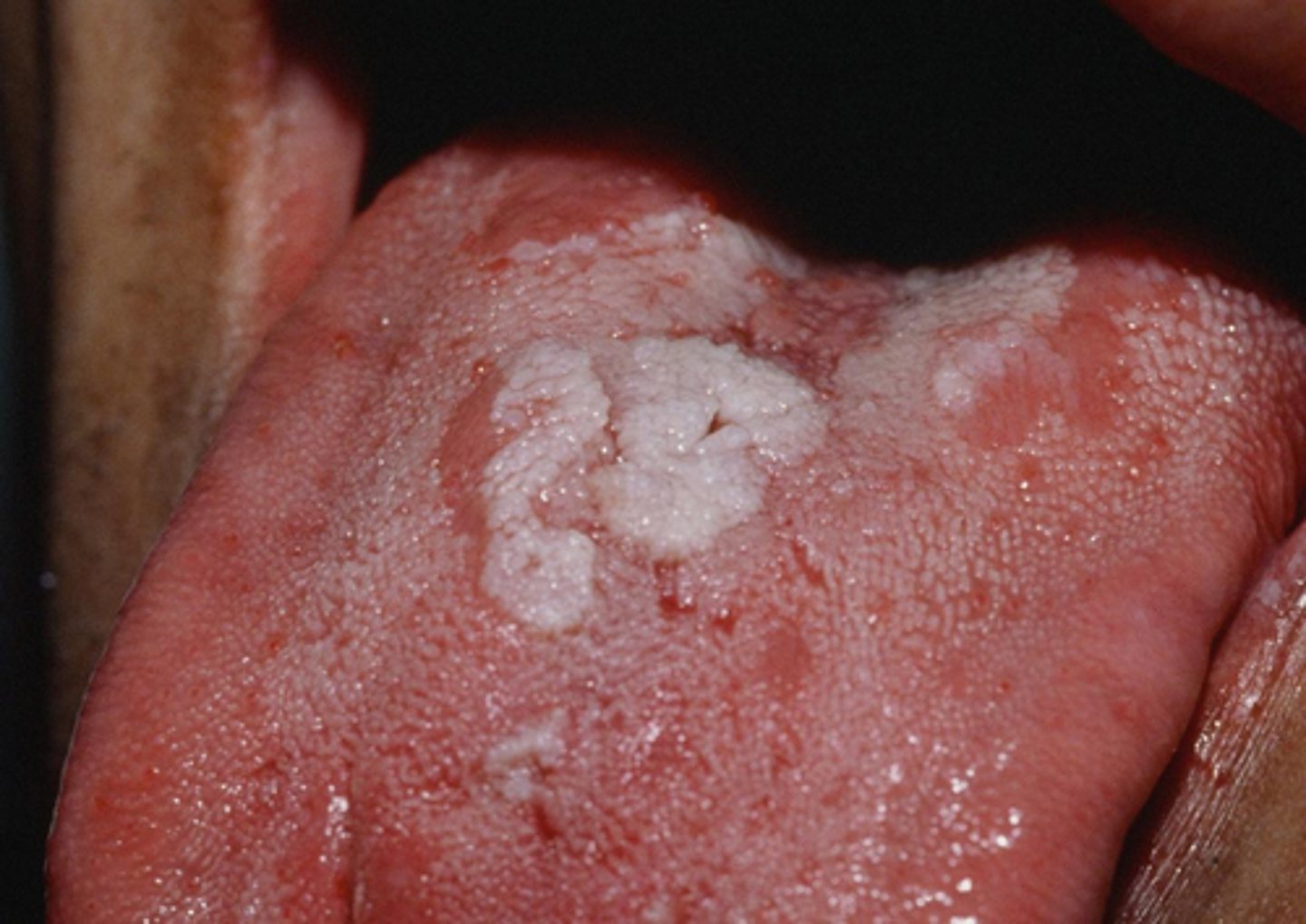 <p>Multiple grayish-white mucosal patches ar present throughout the oral cavity.</p>