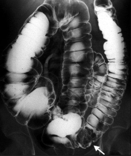 <p>AP Barium Enema: Is this Image Good?</p>