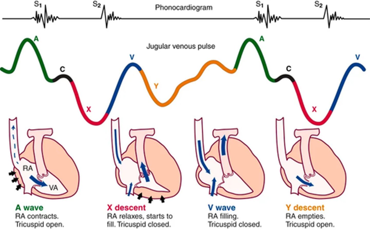 <p>Jugular pulse is diff than the arterial pulse</p><p>(venous pulse results from a backwash, waveform caused by events upstream)</p><p>5 components:</p><p>A wave -> reflects atrial contraction because some blood flows backward to the vena cava during right atrial contraction</p><p>C wave -> or ventricular contraction, is backflow from the bulging upward of the tricuspid valve when it closes at the beginning of ventricular systole</p><p>X Descent -> shows atrial relaxation when the right ventricle contracts during systole and pulls the bottom of the atria downward.</p><p>V wave -> occurs with passive atrial filling because of the increasing volume in the right atria and increased pressure.</p><p>Y descent -> reflects passive ventricular filling when the tricuspid valve opens and blood flows from the RA to the RV.</p>