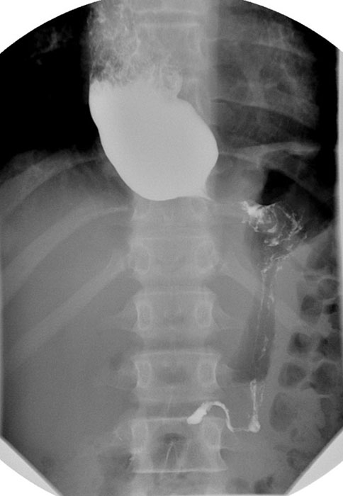 <p>What may be seen on chest X-ray for achalasia?</p>