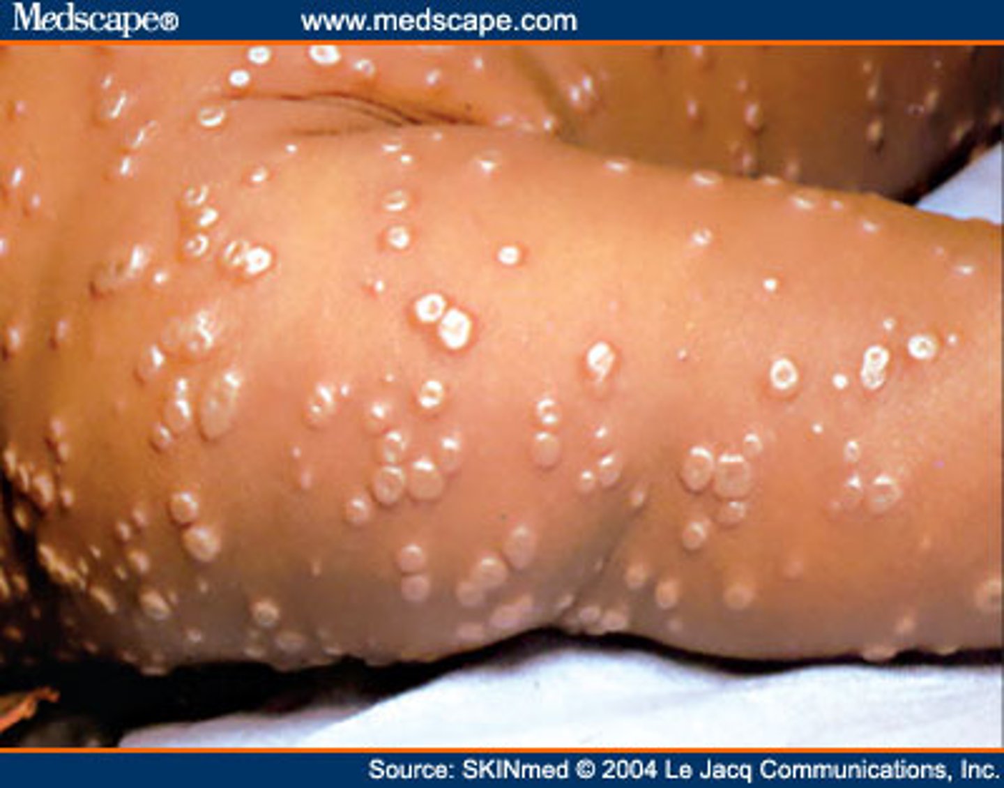 <p>Variola major has 20-60% mortality</p><p>Variola minor has <1% mortality</p>