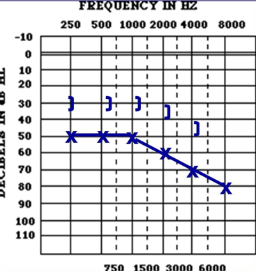 <p>What kind of hearing loss is shown?</p><p>AC: </p><p>BC:</p><p>Air bone gap? </p><p></p>