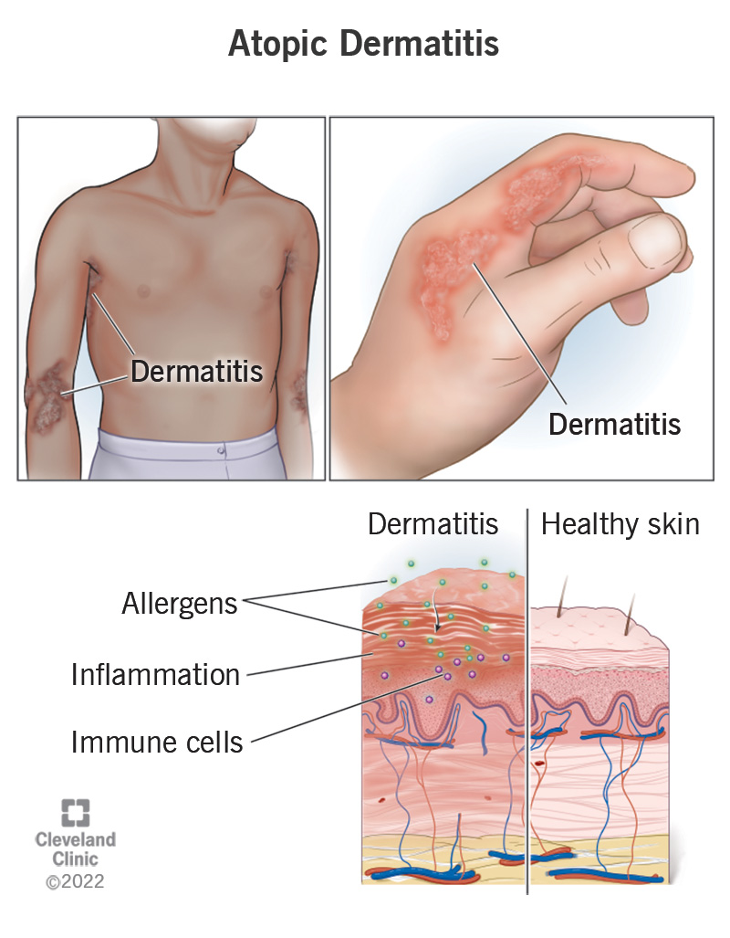 <p>PP: chronic inflammatory skin disease</p><p>RF: asthma<br>allergic rhinoconjunctivitis<br>atopic disorders<br>food allergy (35%)<br>2+ household smoker<br>cats</p><p>E: genetic<br>unknown<br>1st world country kids→30%<br>1 y/o→50%</p><p>CM: pruritis<br>chronic exacerbations+remissions</p><p><u>acute:</u> plaques<br>red<br>thin<br>scaly</p><p><u>chronic:</u> plaques+excoriations<br>thick<br>scaly</p><p><u>infants</u><br>face<br><strong>extensor </strong>surfaces</p><p><u>children</u><br><strong>flexor</strong> surfaces</p><p><u>adults</u><br>localized</p><p><u>POC</u><br>lichenification<br>prurigo-like lesions<br>hyperpigmentation</p>
