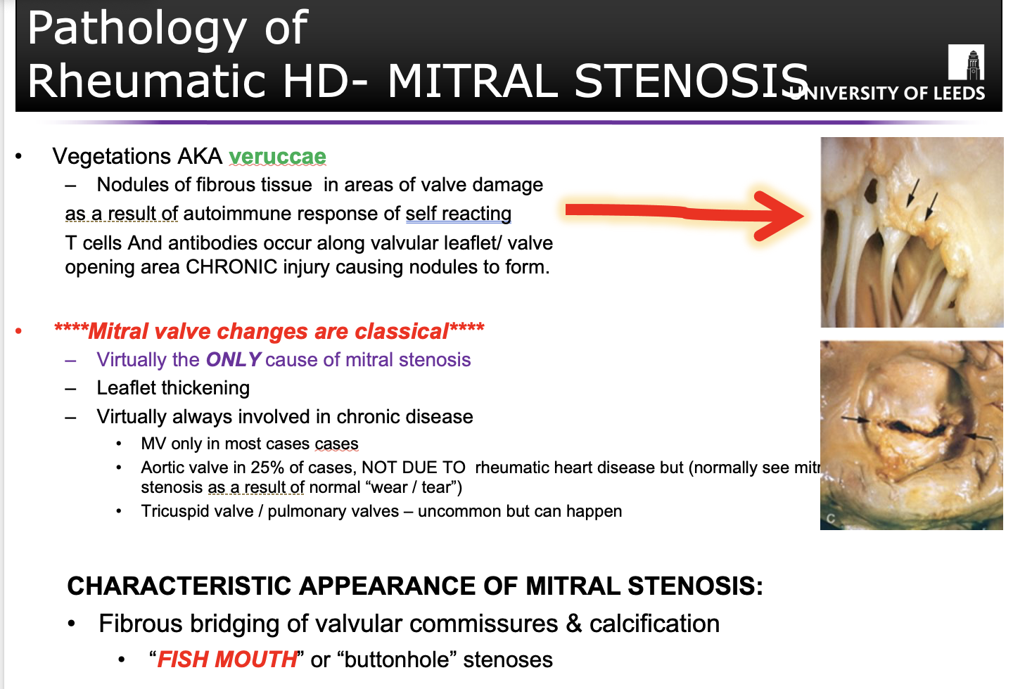 <p><strong>Rheumatic heart disease</strong>, only cause of <strong>mitral stenosis</strong>&nbsp;as a result of <strong><u>acute rheumatic fever.</u></strong></p>