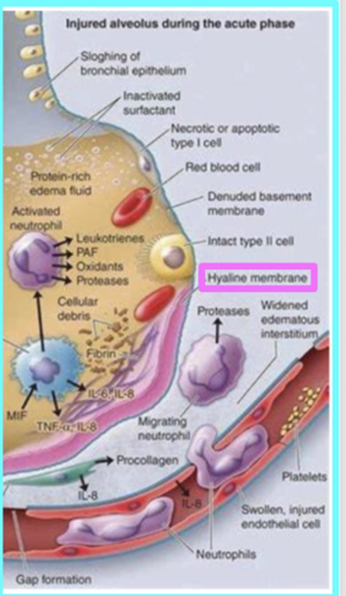 <p>Tissue damage from RDS results in cellular and serum proteins accumulating in the partially collapsed alveoli </p><p>Has nothing to do w/ cartilage </p>