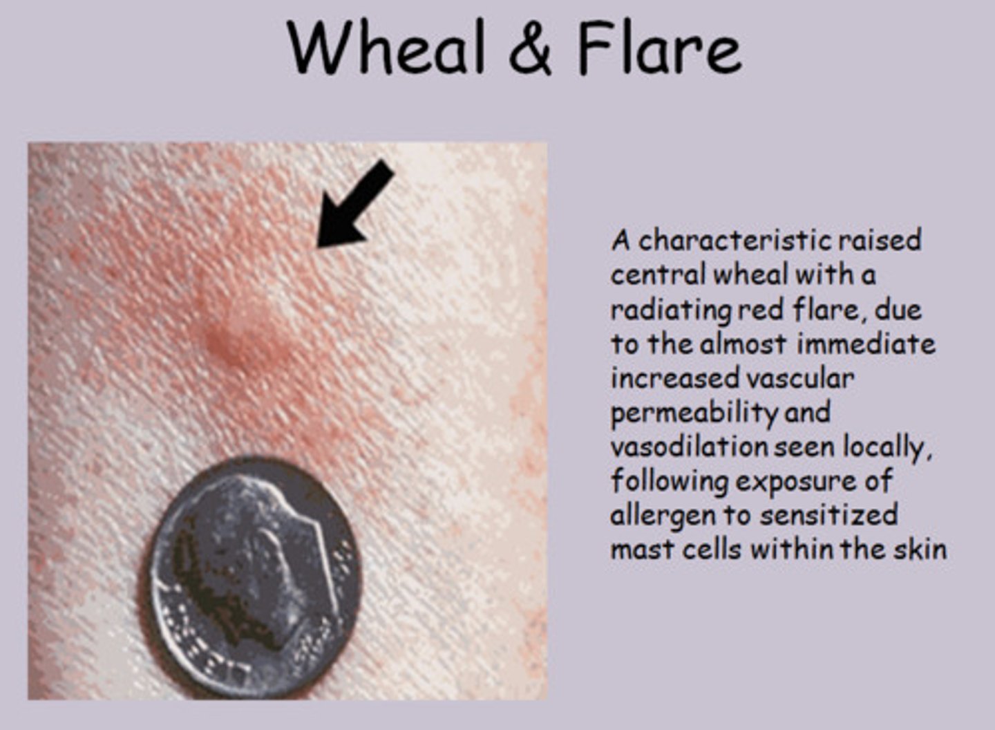 <p>Rash/Hives that appear due to release of serum into tissues (swelling) and dilation of blood vessels (redness)</p>