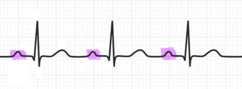 <p><strong><em>(Note: Explain what is happening during each)</em></strong></p><ul><li><p>the first small peak is called the <strong>P wave</strong></p></li><li><p><span>the atria are depolarizing and contracting</span></p></li></ul><p></p>