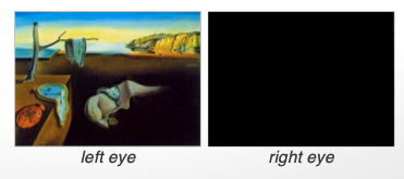 <ul><li><p>loss of sight in one eye</p></li><li><p>destruction of retina/optic tract</p></li></ul><p></p>
