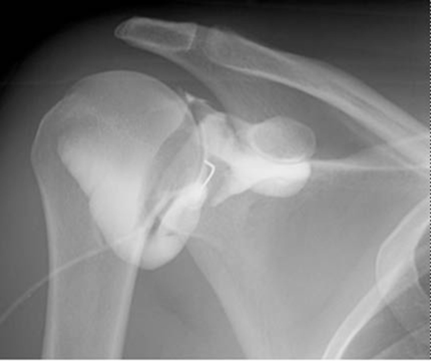 <p>- An image made of a joint after it has been injected with a contrast</p><p>- There are conventional arthrography and MRI and CT arthrography</p>