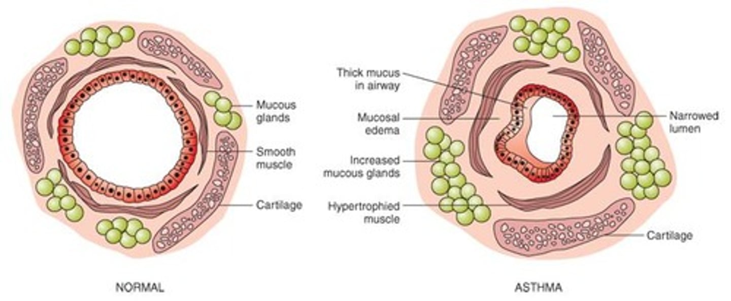 <p>Reversible airway obstruction, airway inflammation, and increased airway responsiveness.</p>