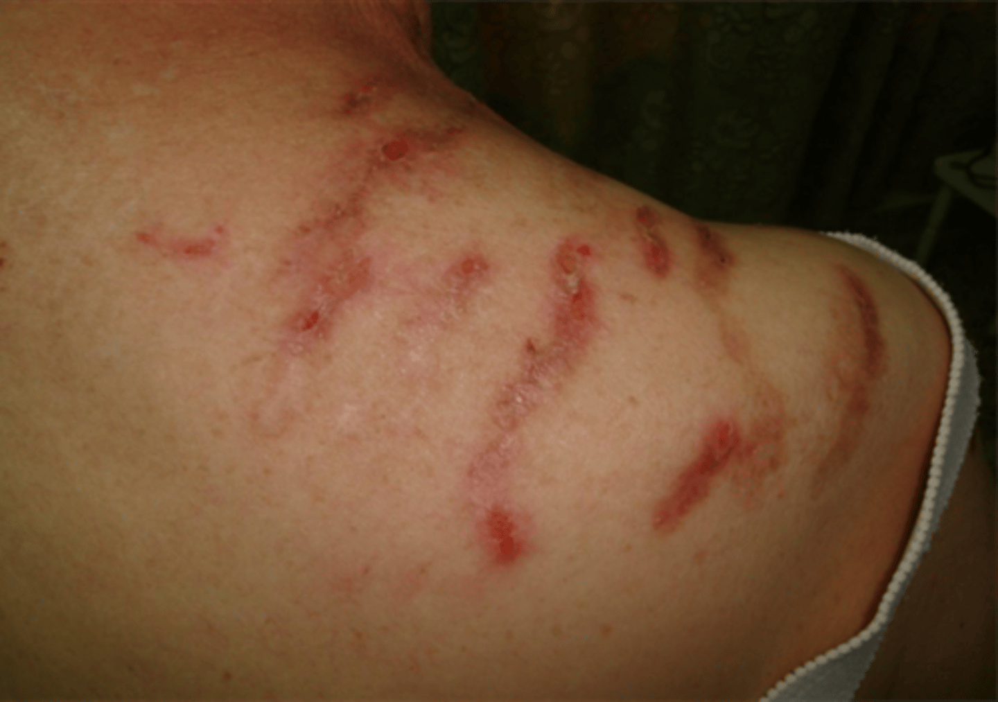 <p>erosion of the skin caused by scratching, rubbing, etc.</p><p>*typically appear as a linear scrape or abrasion</p>