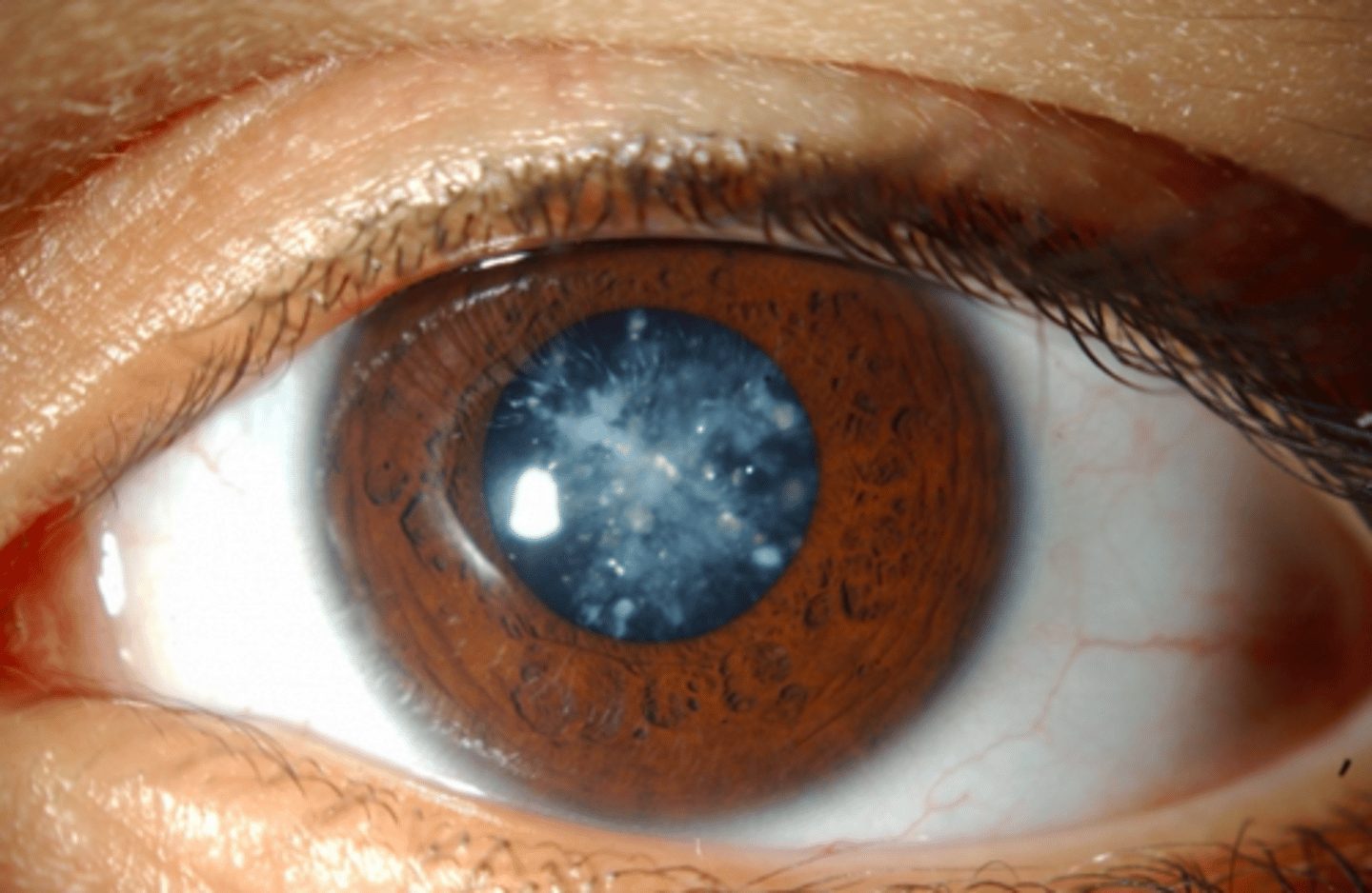 <p>Snowflake cataracts</p>