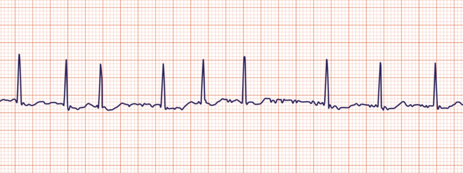 <p>what rhythm is shown in the ECG?</p>
