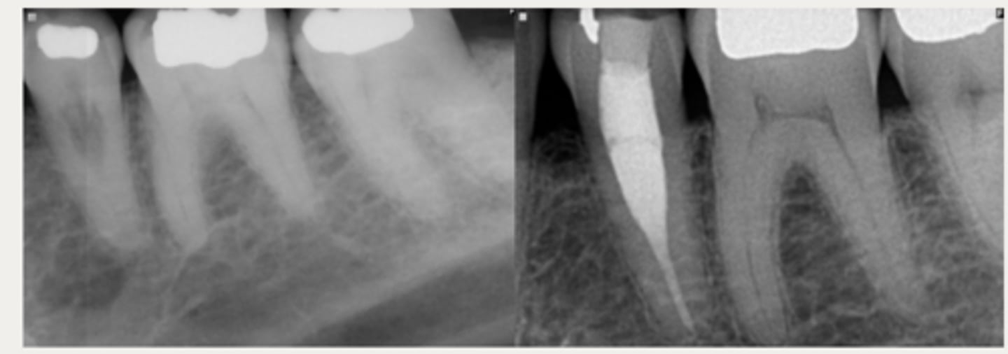 <p>These are a part of which treatment for External Cervical Resorption (ECR)? </p><p>For lesions with a small portal of entry where the resorptive lesion is in close approximation to the chamber/canals</p><p>- Root canal therapy is initiated</p><p>- Resorptive lesion is debrided through the access cavity using 90% TCA or NaOCl</p><p>- Root canal therapy is completed</p><p>- Resorptive defect is restored using RMGI, Biodentine, or Bioceramics (ERRM) depending on the level and extent of the perforation</p>